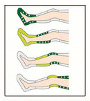 Neomedic CALIBRATED GRADIENT SEQUENTIAL COMPRESSION CIRCULATOR
